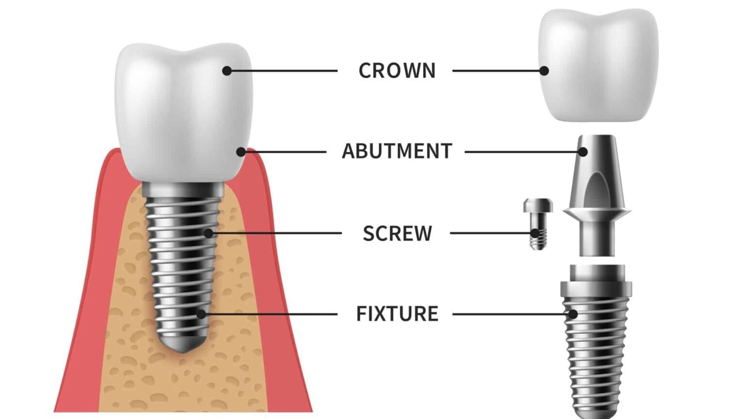Dental Implant Abutment Guide (2025) | Types, Costs & Placement