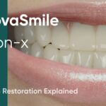 InnovaSmile: The Complete Guide to All-on-X Dental Implants