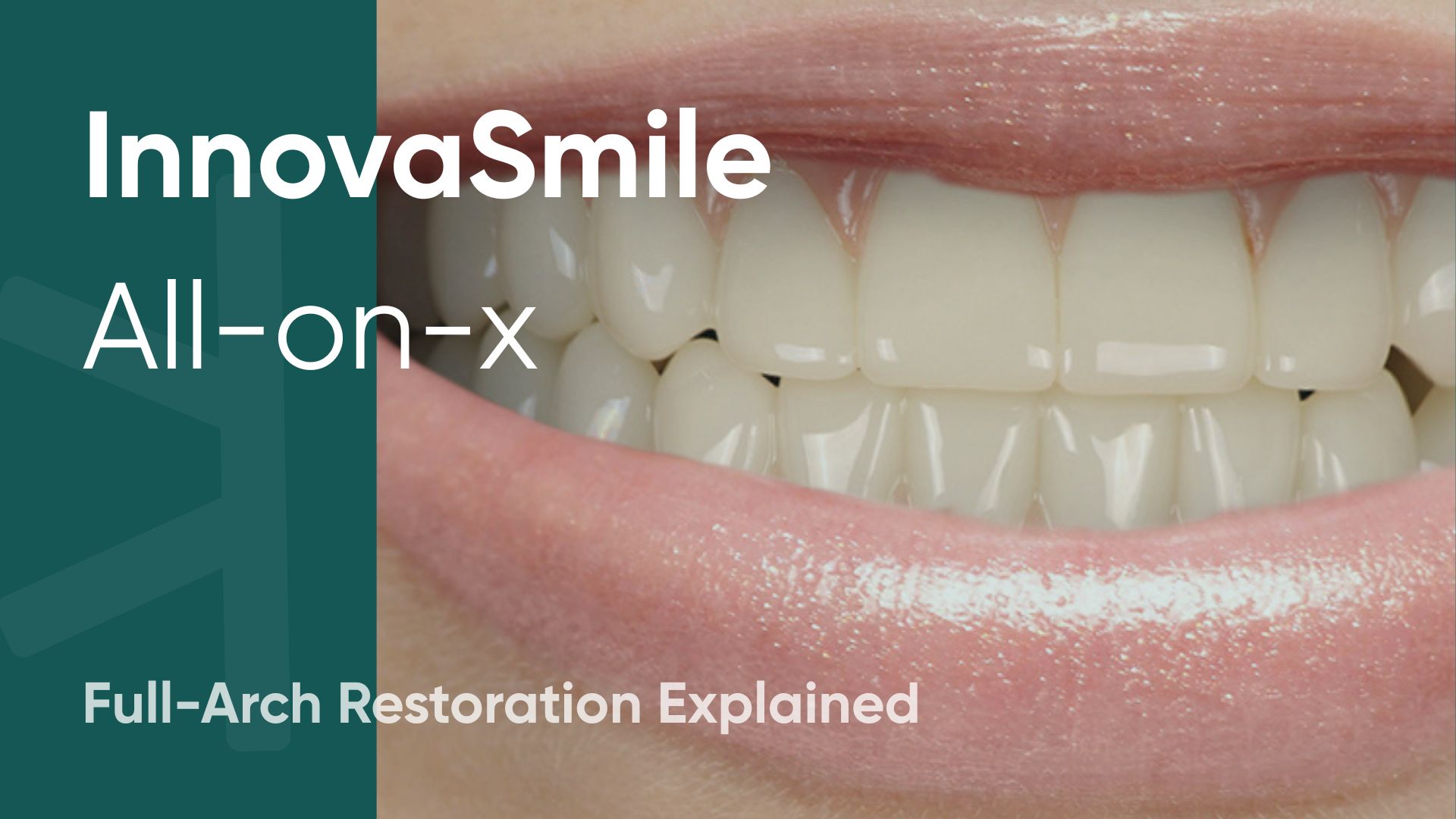 InnovaSmile: The Complete Guide to All-on-X Dental Implants