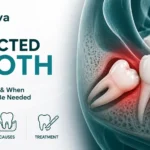 What Is an Impacted Tooth? Signs, Causes, and When Oral Surgery May Be    Needed