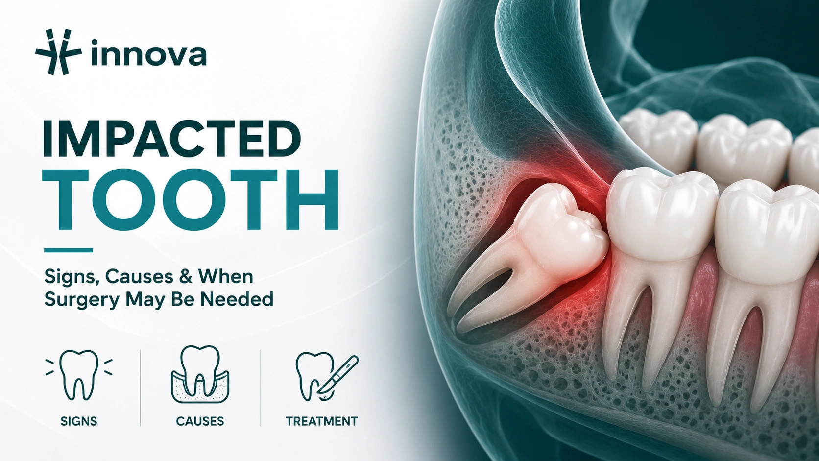 What Is an Impacted Tooth? Signs, Causes, and When Oral Surgery May Be    Needed