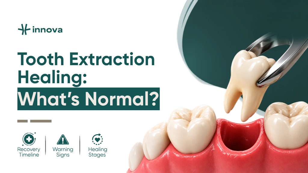 How Long Does a Tooth Extraction Take to Heal?