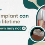 How Long Do Dental Implants Last? Lifespan, Factors, and What to Expect