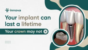 How Long Do Dental Implants Last? Lifespan, Factors, and What to Expect